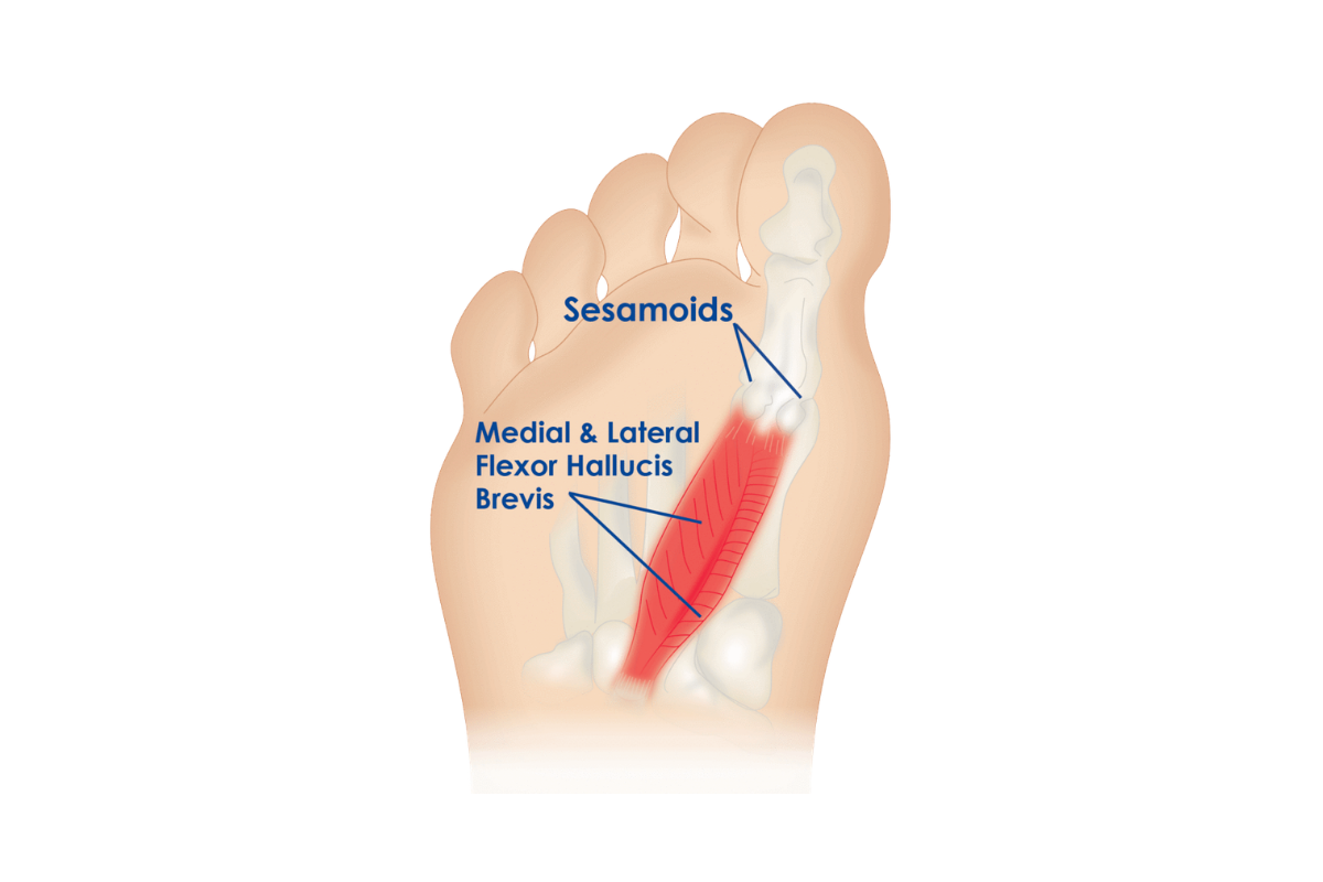 Sesamoiditis