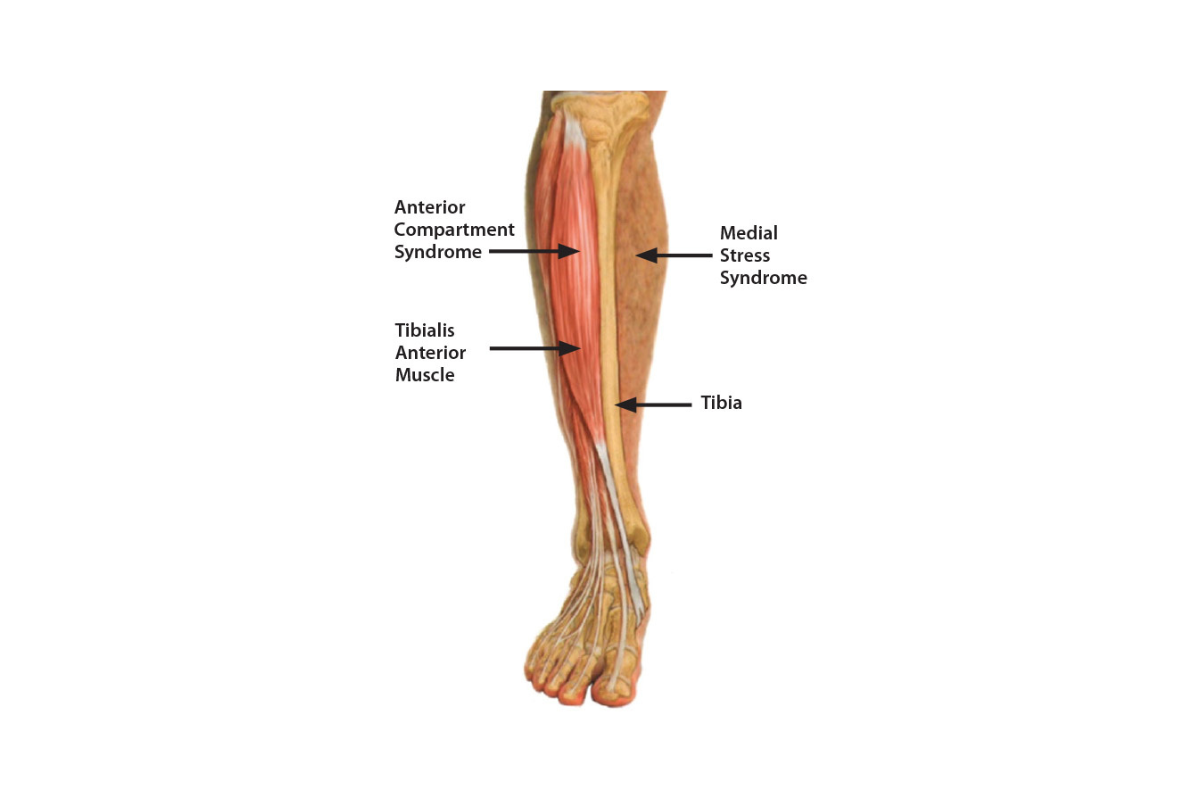 Shin Splints
